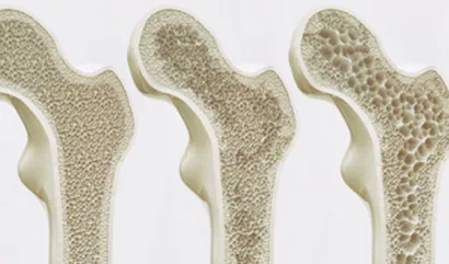 Mieux comprendre l’ostéoporose